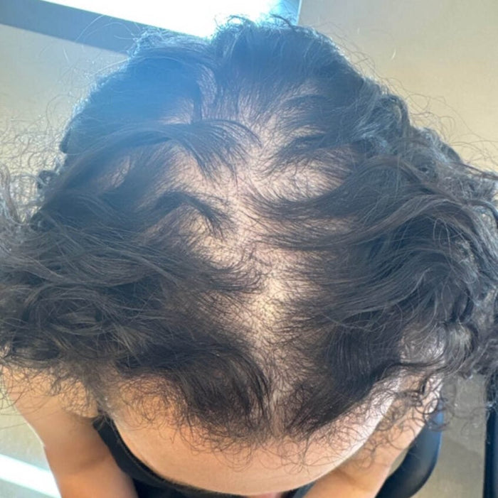 Hair Loss
