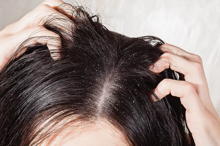 Heavy Dandruff