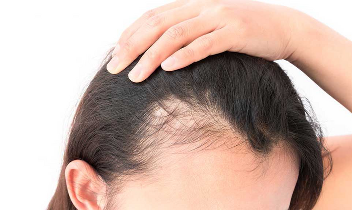 Balding Hairline