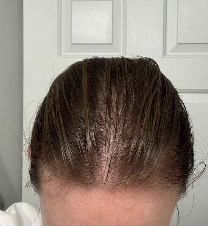 Thinning Hair